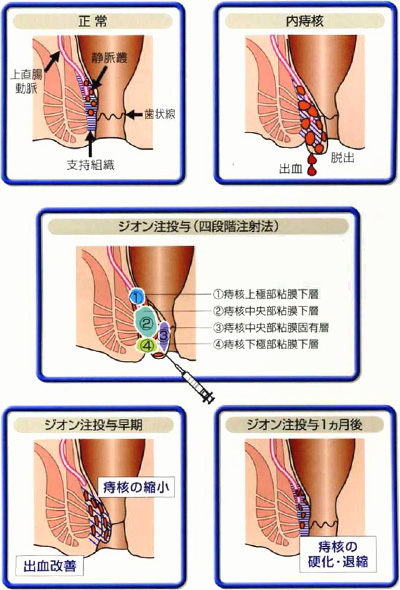 ジオン四段階注射療法