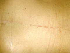当院の手術の傷跡写真